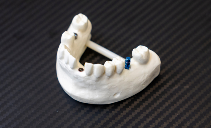 REASON 05 安心安全な国産インプラントメーカーを採用