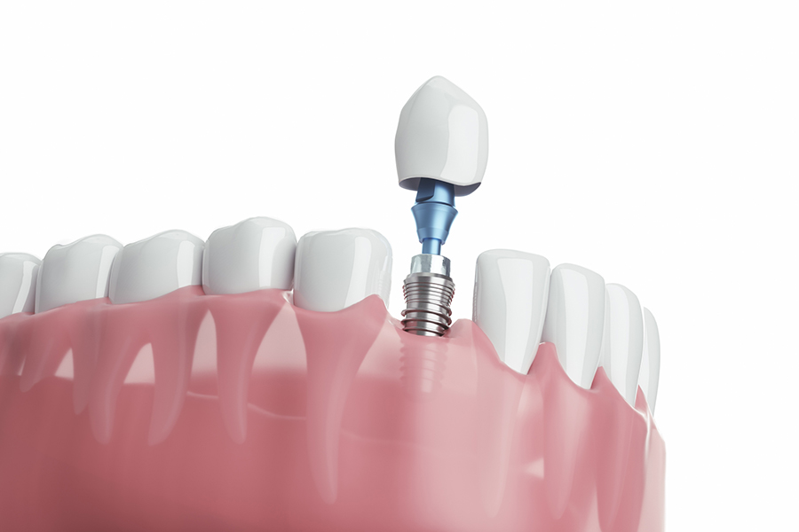 見た目が自然で口元に自信が持てるインプラント
