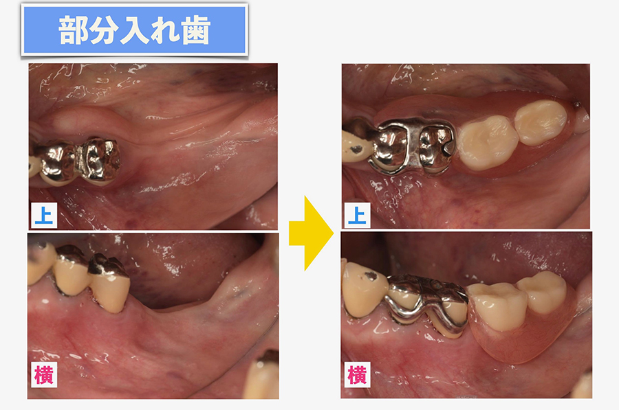 部分入れ歯